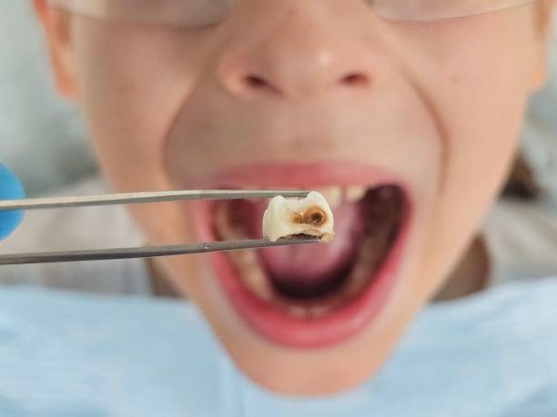 Best Emergency Tooth Extraction in Cranston, RI